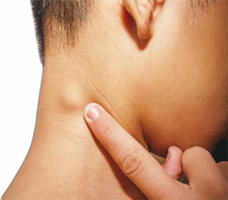 подкожная киста