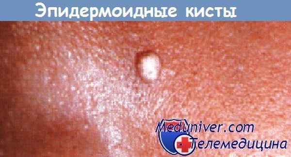Эпидермоидные кисты у ребенка