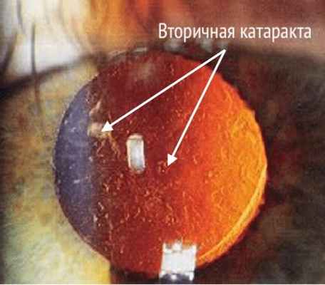 Вторичная катаракта