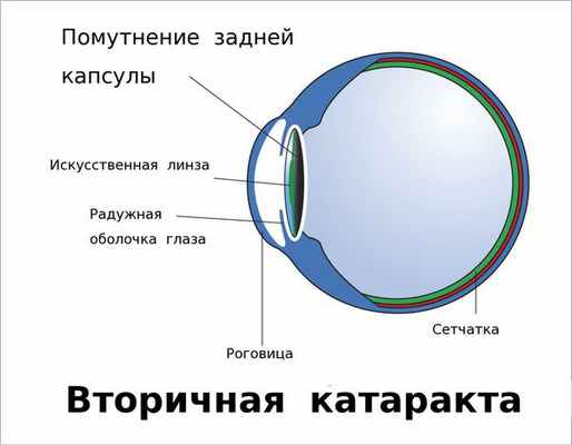 Помутнение задней капсулы хрусталика