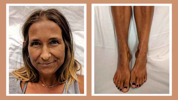 Хроническая надпочечниковая недостаточность