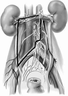пути метастазирования рака яичка