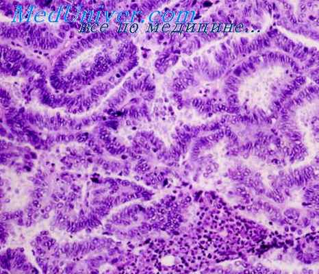 опухоли яичников