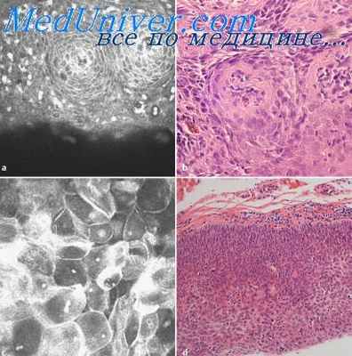 вторичный сифилис