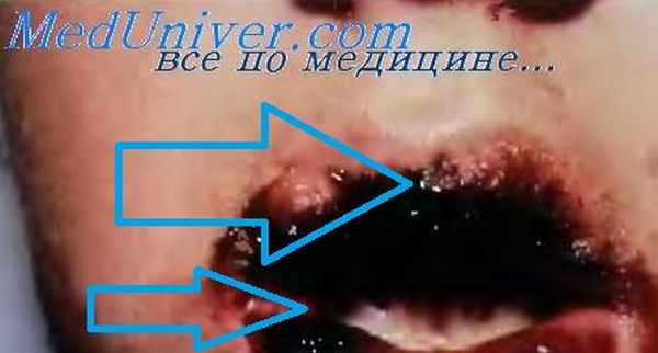 Вульгарная пузырчатка