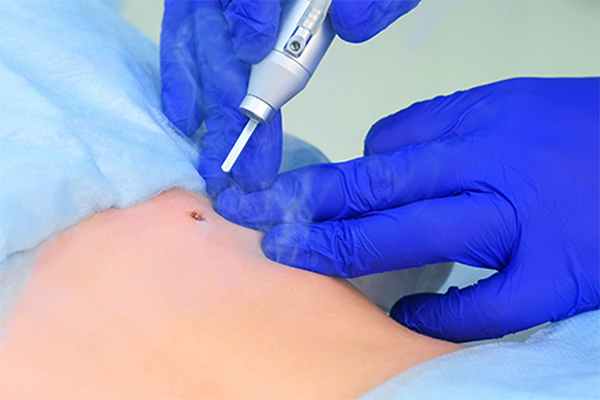 Что такое папилломы