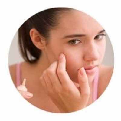 Acne vulgaris (вульгарные угри)