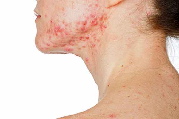 вульгарные угри фото лечение