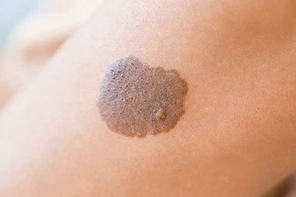 Что такое кератома