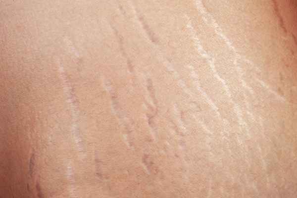 Как удалить растяжки после родов