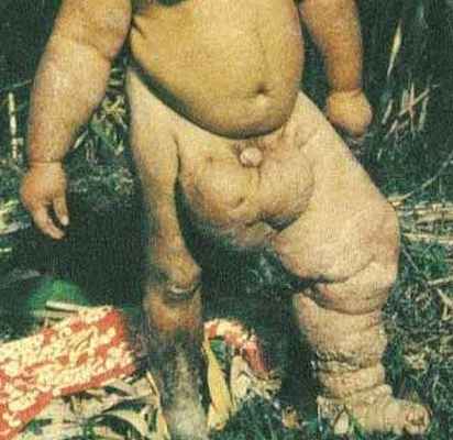 Вухерериоз и бругиоз