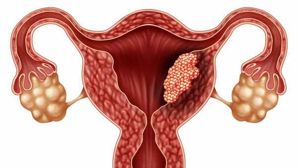Опухоль матки