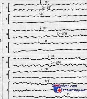 взаимодействие нистагмов