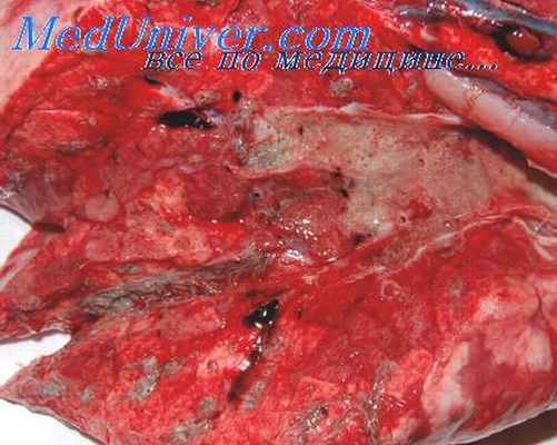 парагонимоз