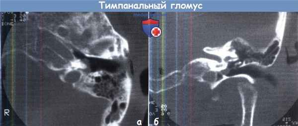 Тимпанальный гломус