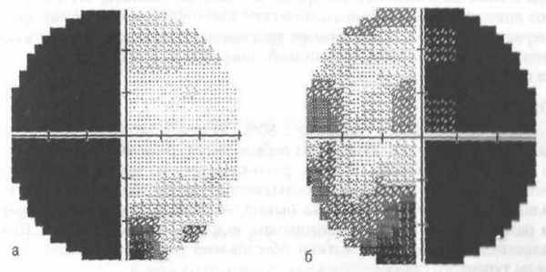 Битемпоральная гемианопсия 