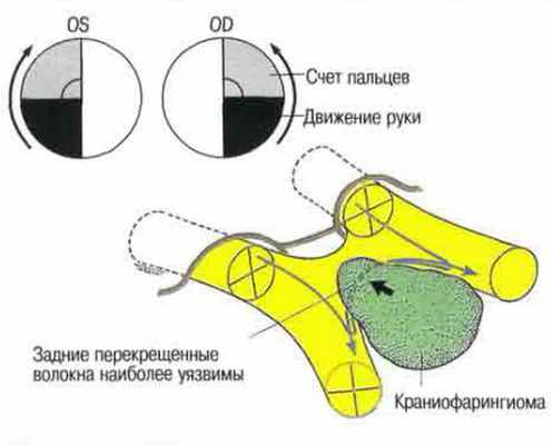 Краниофарингиома