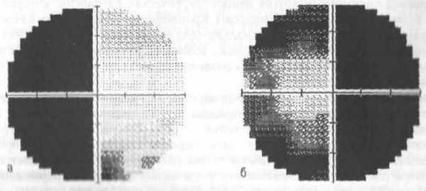 Асимметричный хиазмальный синдром