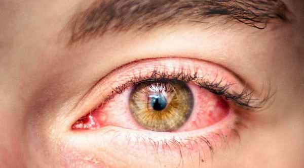 чем снять аллергический отек