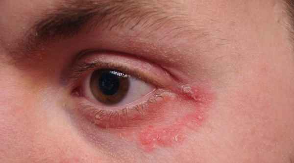 аллергия вокруг глаз