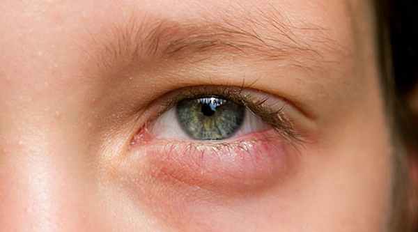 отек слизистой глаза причины