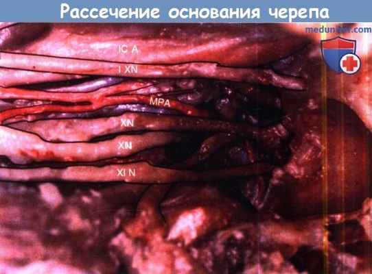 Рассечение основания черепа