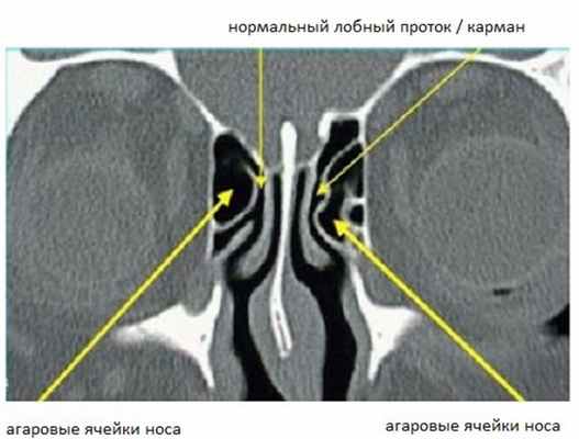 Нормальный лобный проток / карман
