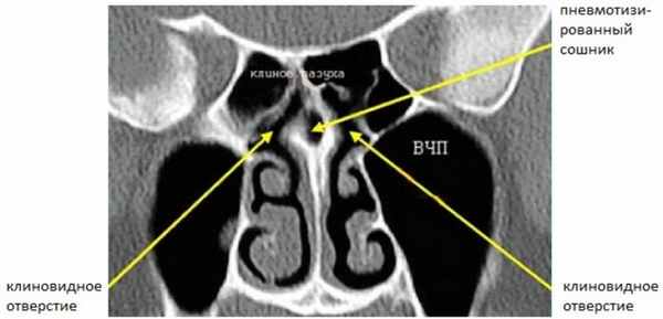 Нормальный задний остиомеатальный комплекс