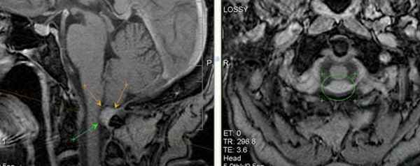  МРТ-исследование при выявлении платибазии