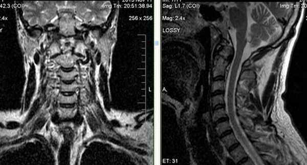  МРТ-исследование при выявлении платибазии