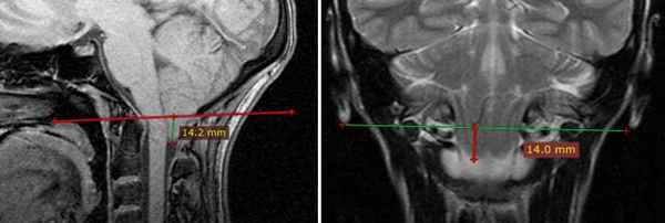  МРТ-исследование при выявлении платибазии