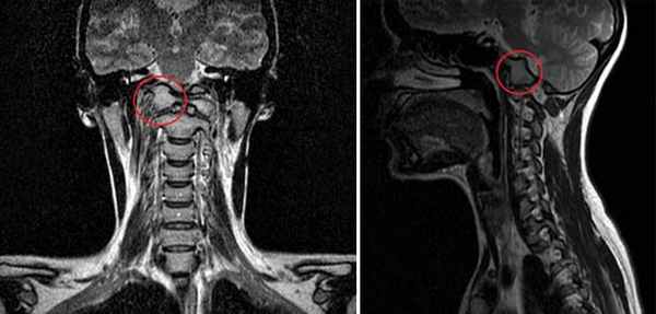  МРТ-исследование при выявлении платибазии
