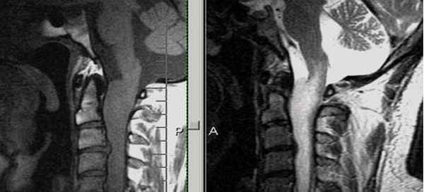  МРТ-исследование при выявлении платибазии