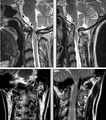  МРТ-исследование при выявлении платибазии