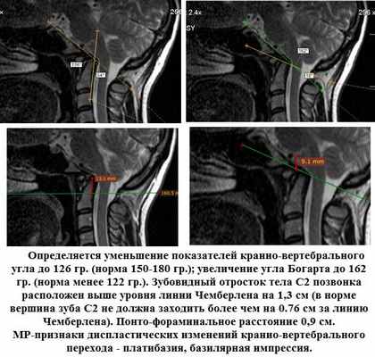  МРТ-исследование при выявлении платибазии