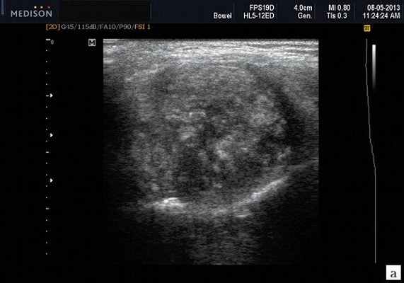 Эхограмма - плеоморфная аденома слюнных желез (а)