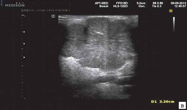 Эхограмма - плеоморфная аденома слюнных желез (в)