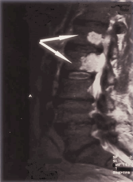 МРТ снимок позвоночника