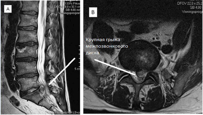 МРТ пояснично-крестцового отдела позвоночника