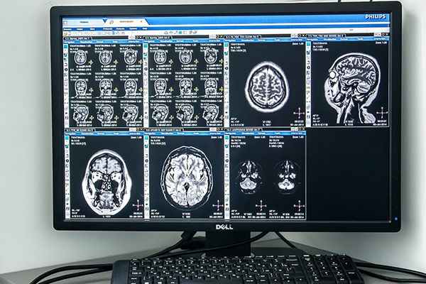 МРТ головы