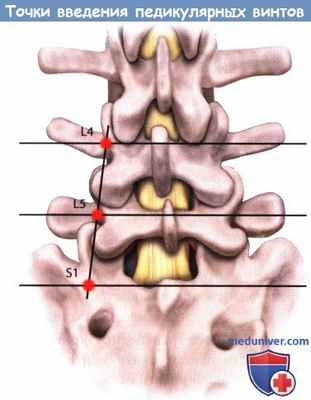 Точки введения педикулярных винтов