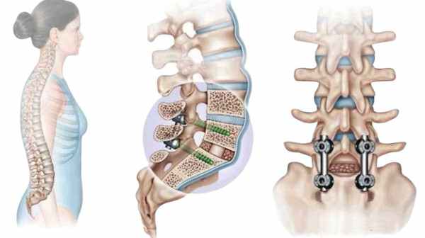 Транспедикулярная фиксация