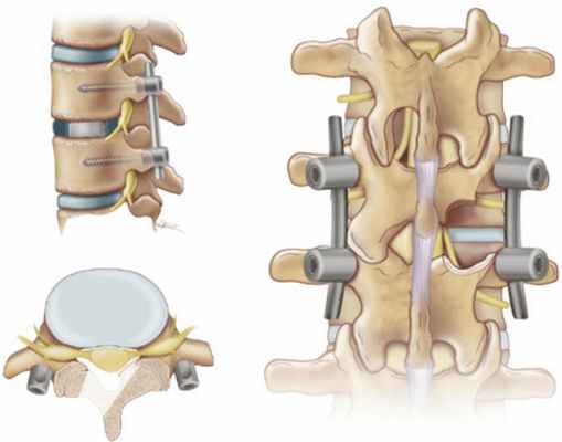 Транспедикулярная фиксация позвоночника