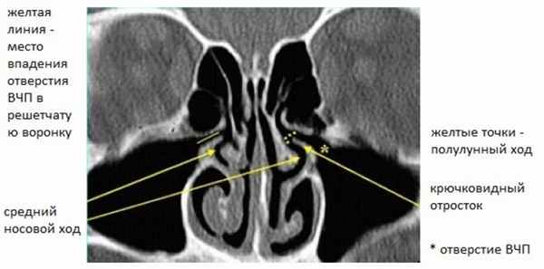 Нормальный передний остиомеатальный комплекс