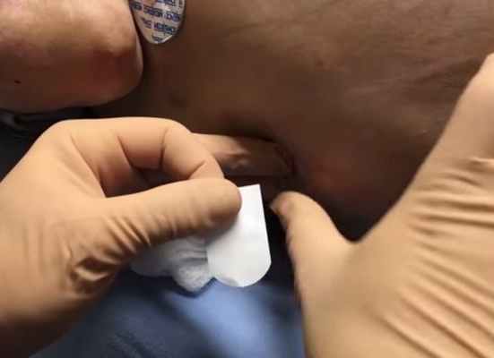 Лапароцентез. Техника операции.