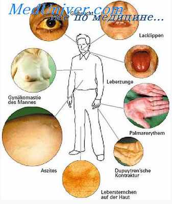 болезни печени