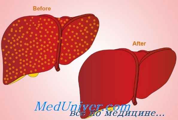 гепаторенальный синдром