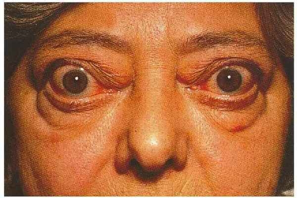 базедова болезнь