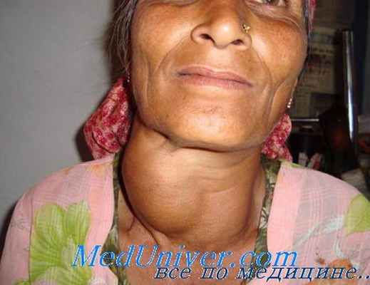 лечение диффузного токсического зоба