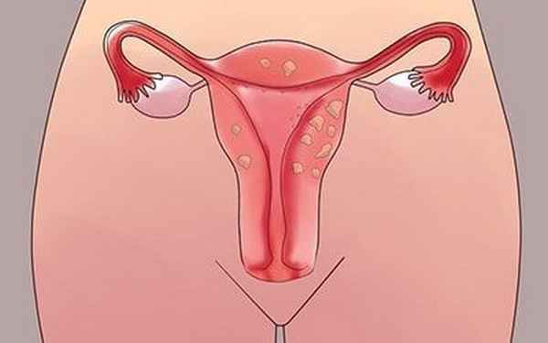 Дисфункциональные маточные кровотечения